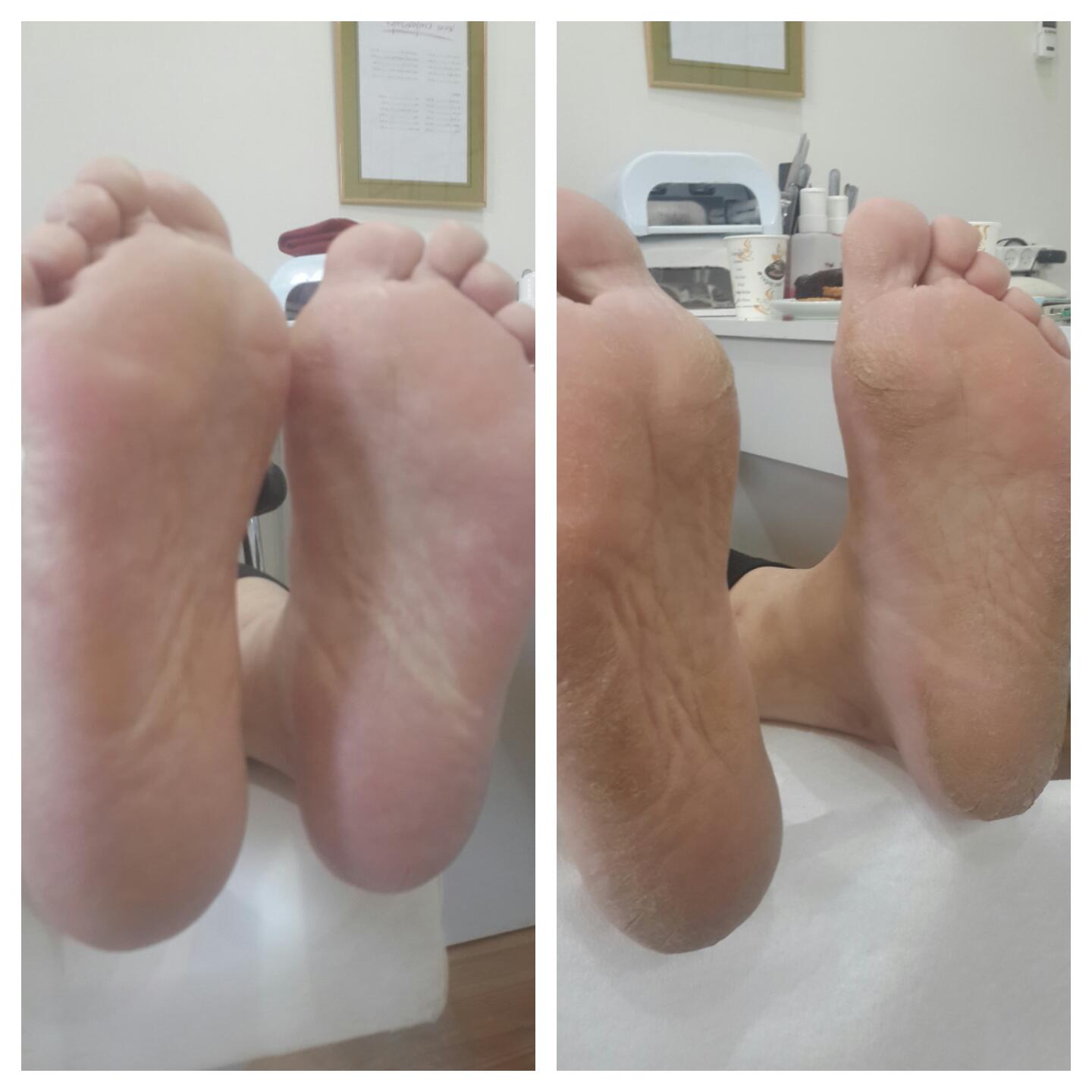טיפול בעור יבש ברגליים
