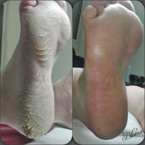 עור יבש ברגליים