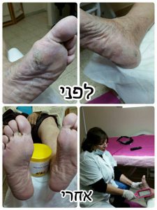 עור יבש ברגליים - לפני ואחרי